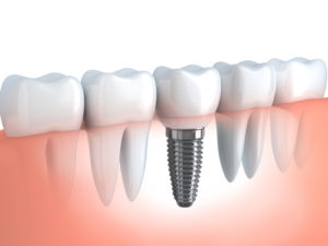 Dental Implants - Dental Clinic - Lucedale, MS