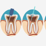 root canals 2